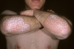 psoriasis
